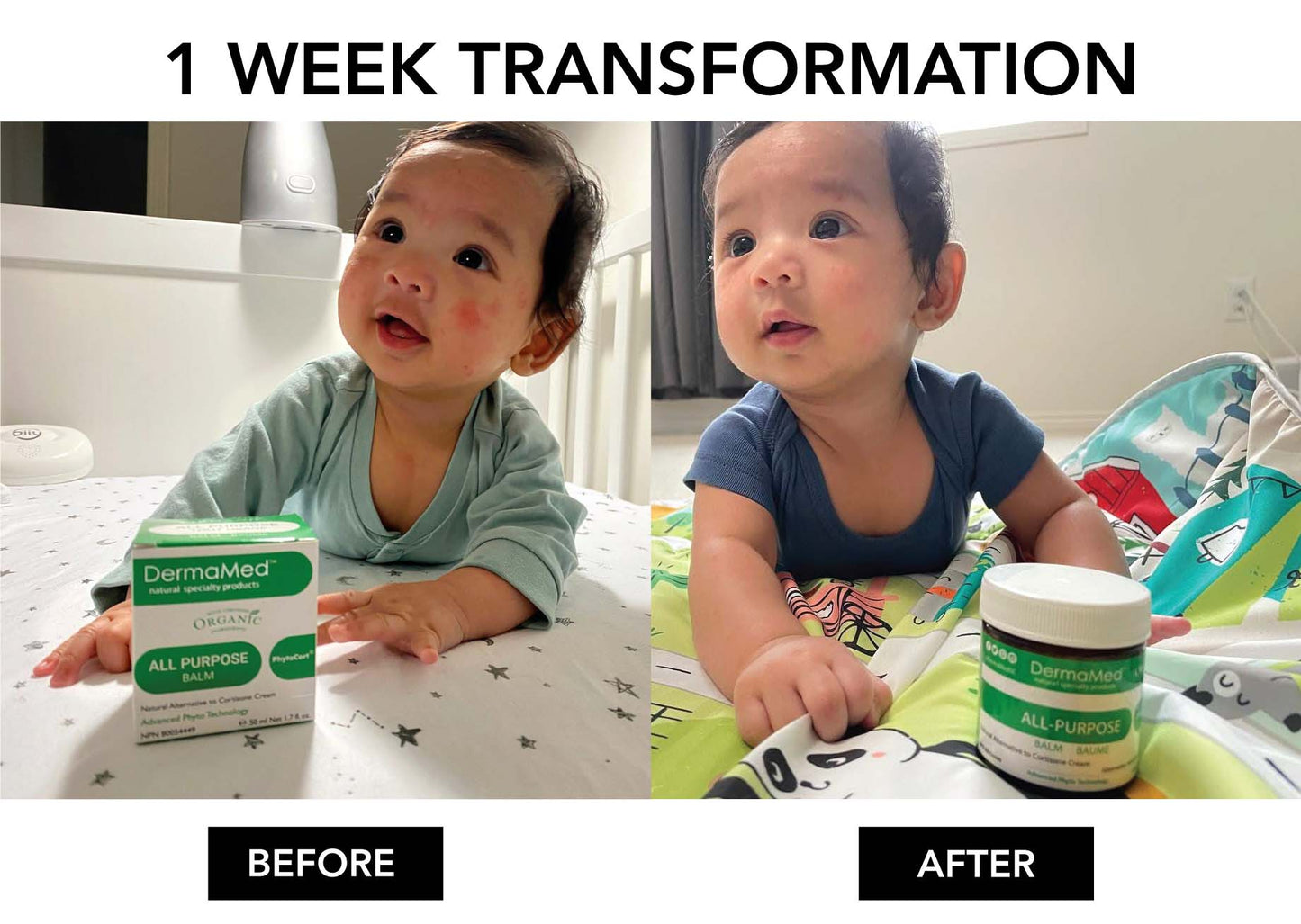 eczema baby healing before after in one week-DermaMed all purpose eczema rash cream 