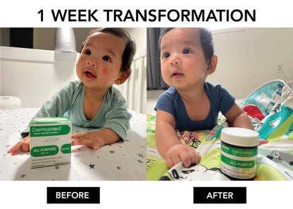 eczema baby healing before after in one week-DermaMed all purpose eczema rash cream 